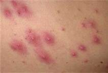 MRSA skin infection